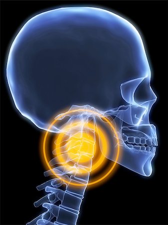 simsearch:400-04900053,k - 3d rendered x-ray illustration of a human head with neck pain Photographie de stock - Aubaine LD & Abonnement, Code: 400-04012470
