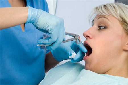 tooth extraction using forceps, scared patient Foto de stock - Super Valor sin royalties y Suscripción, Código: 400-04047134