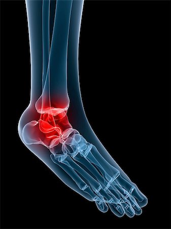 3d rendered illustration of a human skeletal foot with painful ankle Stock Photo - Budget Royalty-Free & Subscription, Code: 400-04071185