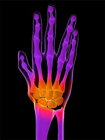 3d rendered anatomy illustration of a painful hand Stock Photo - Budget Royalty-Free & Subscription, Code: 400-04191105