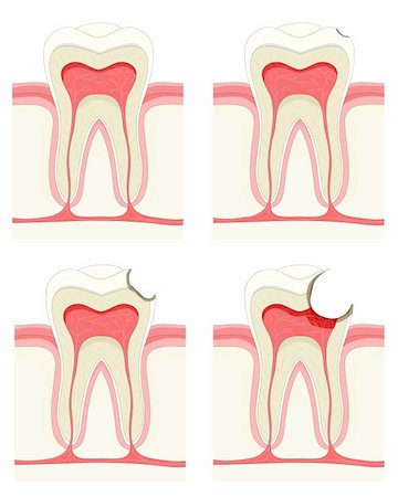 Vector set - tooth. Decay process Stock Photo - Budget Royalty-Free & Subscription, Code: 400-04312316