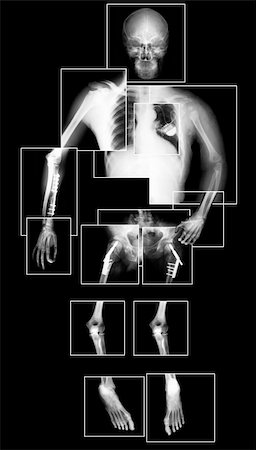 simsearch:400-06394180,k - X-ray picture of human Stock Photo - Budget Royalty-Free & Subscription, Code: 400-04322533