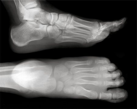 Foot fingers exposed on x-ray black and white film Stock Photo - Budget Royalty-Free & Subscription, Code: 400-04322788