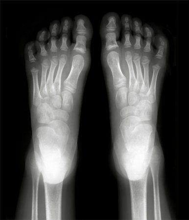 Foot fingers exposed on x-ray black and white film Stock Photo - Budget Royalty-Free & Subscription, Code: 400-04322789