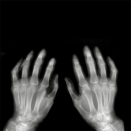 Hands on X-ray film Stock Photo - Budget Royalty-Free & Subscription, Code: 400-04322818
