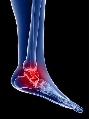 3d rendered anatomy illustration of a human foot with painful ankle Stock Photo - Budget Royalty-Free & Subscription, Code: 400-04549725