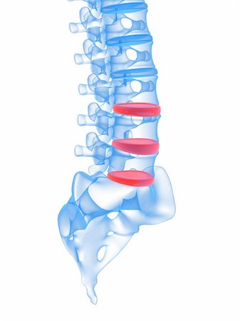 3d rendered illustration of highlighted discs in human spine Stock Photo - Budget Royalty-Free & Subscription, Code: 400-04683330