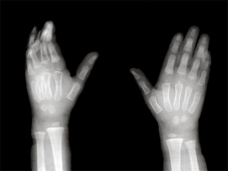 Broken finger on black and white X-ray film Stock Photo - Budget Royalty-Free & Subscription, Code: 400-04823794