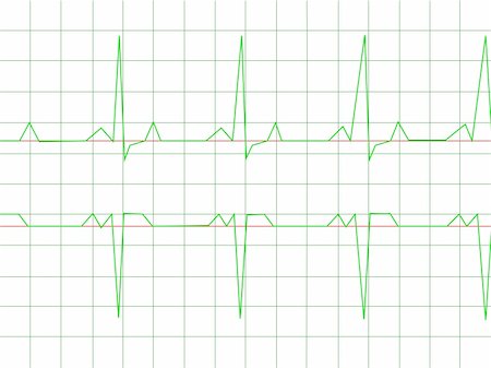 simsearch:400-07222508,k - Normal Heart Rhythm electrocardiogram ECG graph with white background Photographie de stock - Aubaine LD & Abonnement, Code: 400-05139532