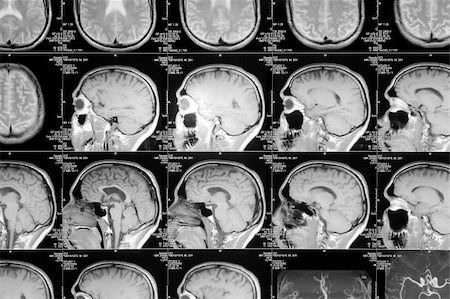 black and white head magnetic resonance image Stock Photo - Budget Royalty-Free & Subscription, Code: 400-05131716