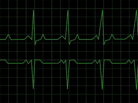 simsearch:400-07222508,k - Normal Heart Rhythm electrocardiogram ECG graph with black background Photographie de stock - Aubaine LD & Abonnement, Code: 400-05142783