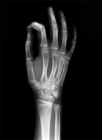 simsearch:400-06394180,k - OK sign on x-ray black and white film Stock Photo - Budget Royalty-Free & Subscription, Code: 400-05312933