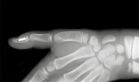 Strange body in human finger on x-ray film Stock Photo - Budget Royalty-Free & Subscription, Code: 400-05312946