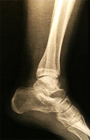 A X-ray of a foot Stock Photo - Budget Royalty-Free & Subscription, Code: 400-05340316
