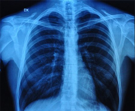 X-Ray Image Of Human Chest front view and lateral view Stock Photo - Budget Royalty-Free & Subscription, Code: 400-05927820