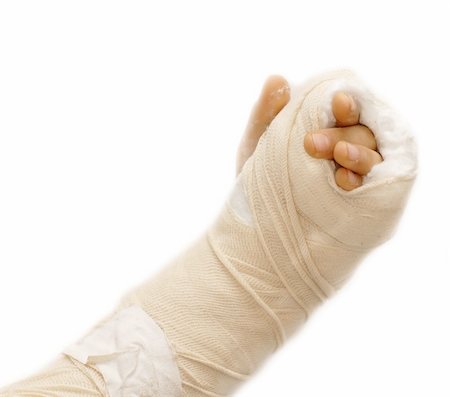 broken arm bone in a cast and bandages over white background isolated Stock Photo - Budget Royalty-Free & Subscription, Code: 400-05946801