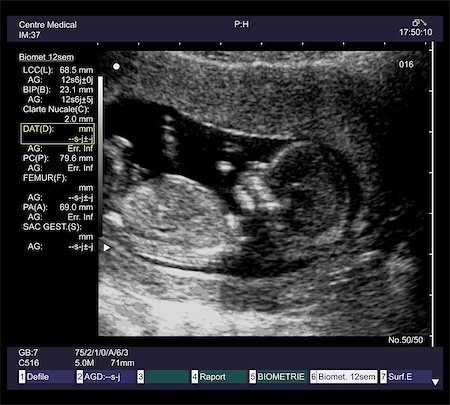 dip (artist) - ultrasound fetus at 12 weeks Stock Photo - Budget Royalty-Free & Subscription, Code: 400-06687553