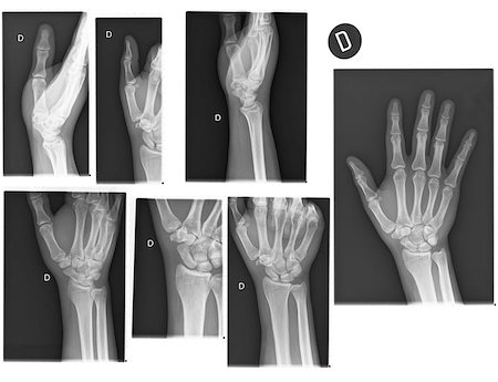 Real X-rays of the Hand and wrist. (broken wrist) Stock Photo - Budget Royalty-Free & Subscription, Code: 400-06798660
