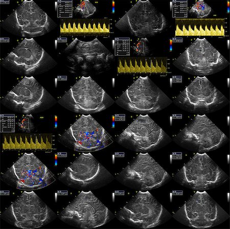 composition of detail ultrasound pictures from ultrasound examination Stock Photo - Budget Royalty-Free & Subscription, Code: 400-07210794