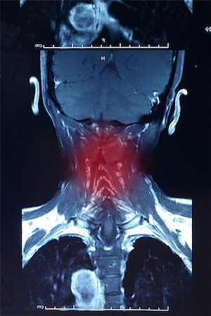 spinal cord of a male - Red point Painful neck X-ray for your know your healthy Stock Photo - Budget Royalty-Free & Subscription, Code: 400-07951551
