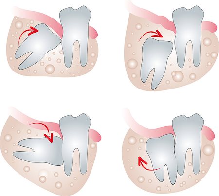 Tooth wisdom Stock Photo - Budget Royalty-Free & Subscription, Code: 400-08046613