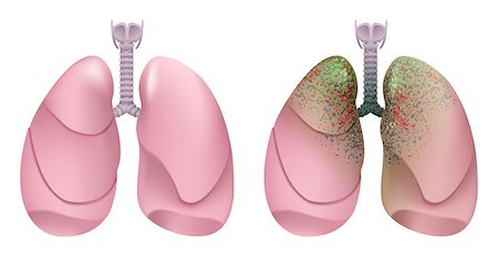 Healthy human lungs. Respiratory system. Lung, larynx and trachea of healthy person. Respiratory system smoker. Lung cancer. Isolated on white vector illustration Stock Photo - Budget Royalty-Free & Subscription, Code: 400-08379601