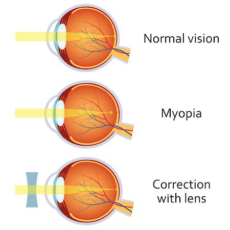 simsearch:400-04751617,k - Myopia and myopia corrected by a minus lens. Eye vision disorder. Also available as a Vector in Adobe illustrator EPS 10 format. Stock Photo - Budget Royalty-Free & Subscription, Code: 400-08532244