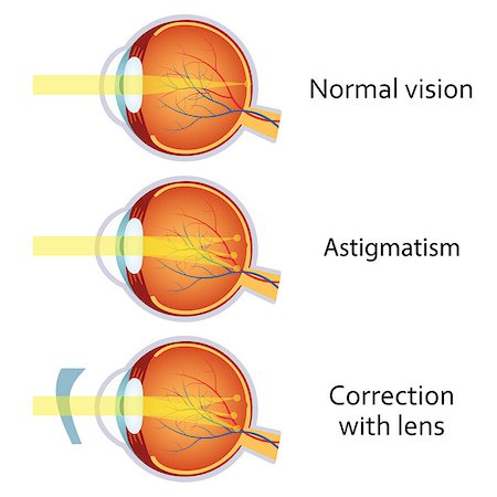 simsearch:400-04751617,k - Astigmatism corrected by a cylindrical lens. Eyesight problem, blurred vision. Anatomy of the eye, cross section. Also available as a Vector in Adobe illustrator EPS 10 format. Stock Photo - Budget Royalty-Free & Subscription, Code: 400-08652350