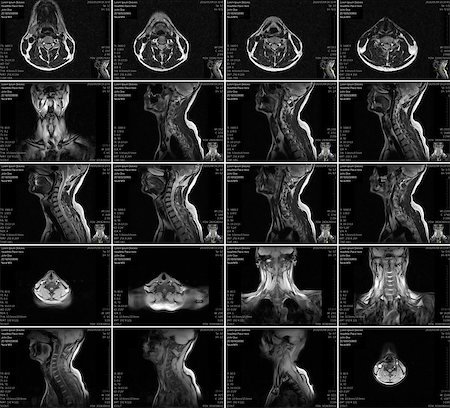 sermax55 (artist) - Magnetic resonance imaging of the cervical spine. MRI vertebral discs in different views Stock Photo - Budget Royalty-Free & Subscription, Code: 400-08706136