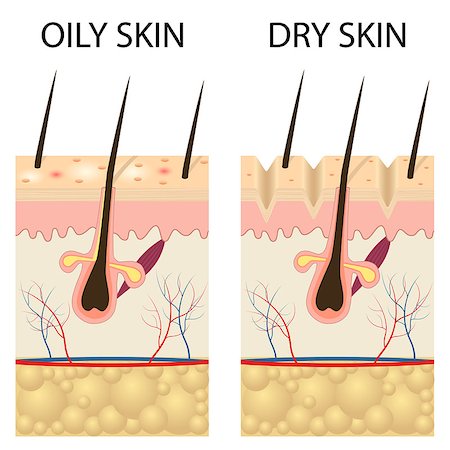 dehydrated - Human Skin types and conditions. Dry and oily. A diagrammatic sectional view of the skin. Also available as a Vector in Adobe illustrator EPS 10 format. Foto de stock - Super Valor sin royalties y Suscripción, Código: 400-08965334