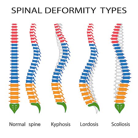 deformity - Illustration of spinal deformity types. Kyphosis, lordosis and scoliosis. Also available as a Vector in Adobe illustrator EPS 10 format. Stock Photo - Budget Royalty-Free & Subscription, Code: 400-09000460