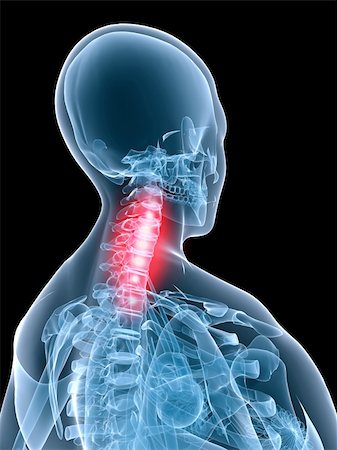 simsearch:400-04900053,k - 3d rendered anatomy illustration of a skeletal female back wit a painful neck Photographie de stock - Aubaine LD & Abonnement, Code: 400-03979554