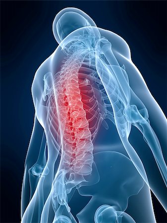 simsearch:400-04900053,k - 3d rendered anatomy illustration of a human skeletal back with pain Photographie de stock - Aubaine LD & Abonnement, Code: 400-03993666