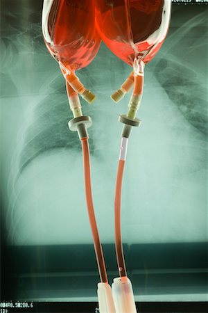 dripping blood - IV Drip Bags and X-Ray Stock Photo - Premium Royalty-Free, Code: 600-00947807