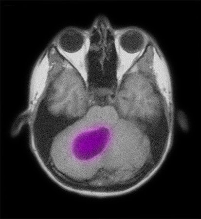 photographs of human bones - MRI of the brain showing an astrocytoma tumor Stock Photo - Premium Royalty-Free, Code: 614-08870049
