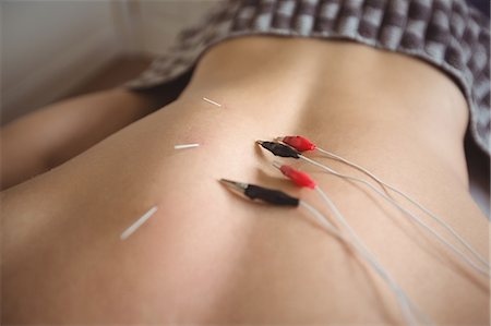 Mid section of a patient getting electro dry needling on his back Stock Photo - Premium Royalty-Free, Code: 6109-08829809