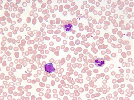 red blood cell - Close up of myelogenous leukemia cells Stock Photo - Premium Royalty-Free, Code: 649-05801916