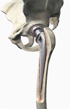 Hip replacement Stock Photo - Premium Royalty-Free, Code: 671-02101729