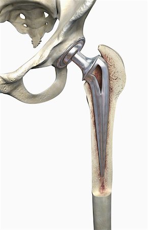 Hip replacement Stock Photo - Premium Royalty-Free, Code: 671-02101750