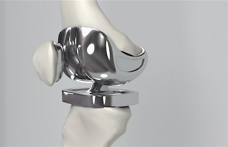 Knee replacement Stock Photo - Premium Royalty-Free, Code: 671-02101990