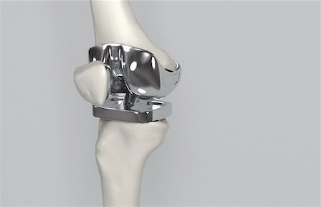 Knee replacement Stock Photo - Premium Royalty-Free, Code: 671-02102554