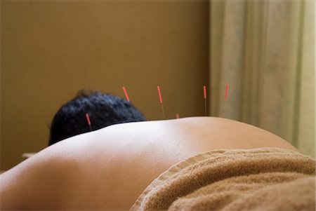 Man receiving acupuncture treatment Stock Photo - Premium Royalty-Free, Code: 685-02941869
