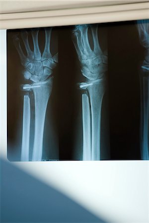 X-ray displaying injured radius and ulna Stock Photo - Premium Royalty-Free, Code: 695-05770666
