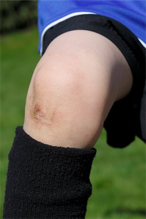 Gros plan d'une éraflure sur le genou de l'enfant Photographie de stock - Rights-Managed, Code: 700-05973890