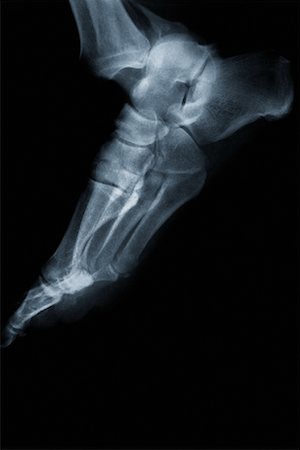 Foot X-Ray Stock Photo - Rights-Managed, Code: 700-00094786