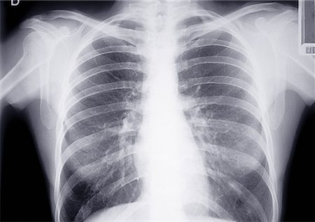 Chest X-Ray Stock Photo - Rights-Managed, Code: 700-00193943