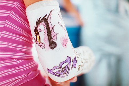 plaster (medical cast) - Close Up of Arm in Cast Stock Photo - Rights-Managed, Code: 700-00424742