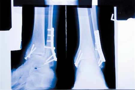 X-rays of Injuries Stock Photo - Rights-Managed, Code: 700-02264333