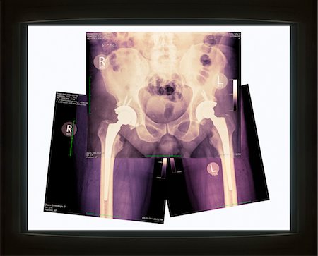 pelvic bone - X-rays on Light Box showing Double Hip Replacement Stock Photo - Rights-Managed, Code: 700-03466372