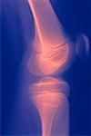 Radiographie articulation du genou